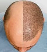 Hair Transplant