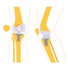 Knee Replacement