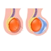 Hydrocele