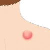 Sebaceous cyst