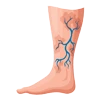 Varicose Veins