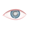 Cataract
