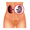 Kidney Stone