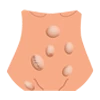 Hernia Treatment