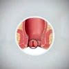 Anal Fissure