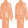 Gynaecomastia