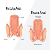 Anal Fistula