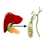 Gallstone