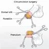 Circumcision