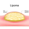 Lipoma Removal